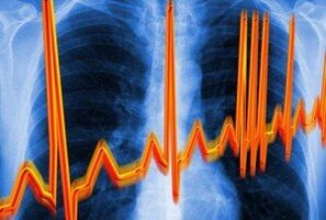 Osteokondroz için kalp aritmi