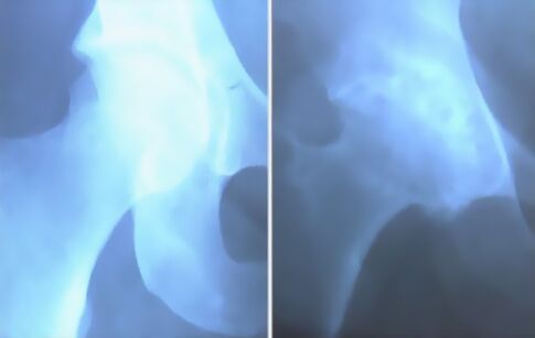 Diz ekleminin arkrozun pisliği