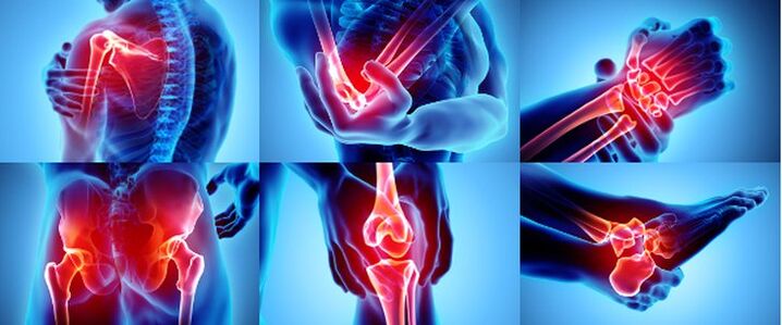 İltihaplı eklemler